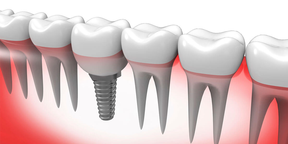 Graphic of Implant